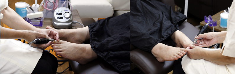 巻き爪施術イメージ